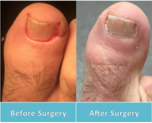 Ingrown surgery after toenail numb still toe Problems after